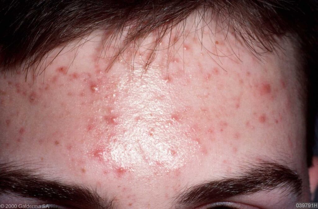 Trattamento Acne