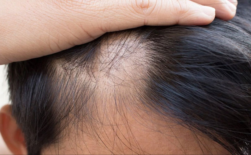 Trattamento alopecia