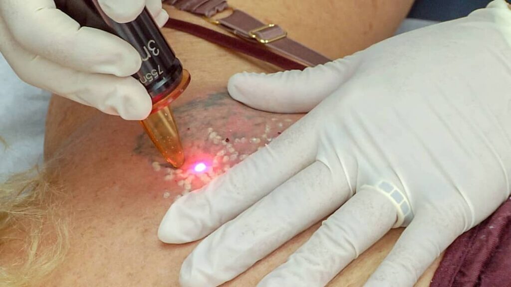 Rimozione di un tatuaggio con laser