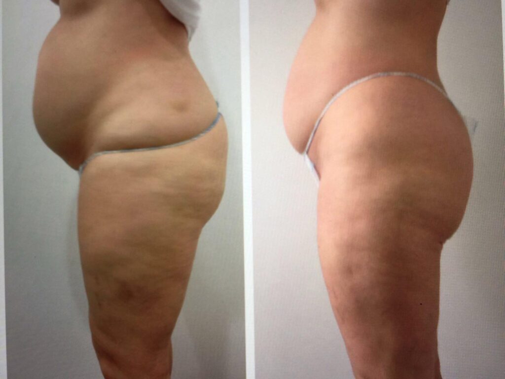 Prima e dopo di una trasformazione fisica a Brescia, Italia, con una persona in lingerie bianca vista di lato, mostrando una riduzione di grasso corporeo dovuta a criolipolisi