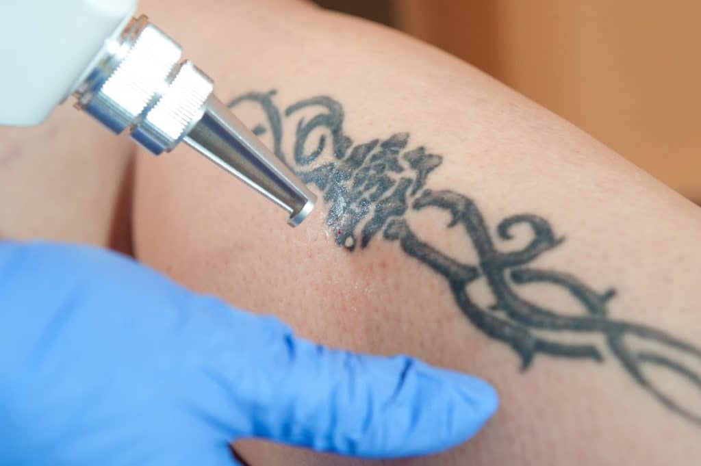 Rimozione tatuaggi neri e colorati, tatuaggi cosmetici e tatuaggi da trauma a Brescia