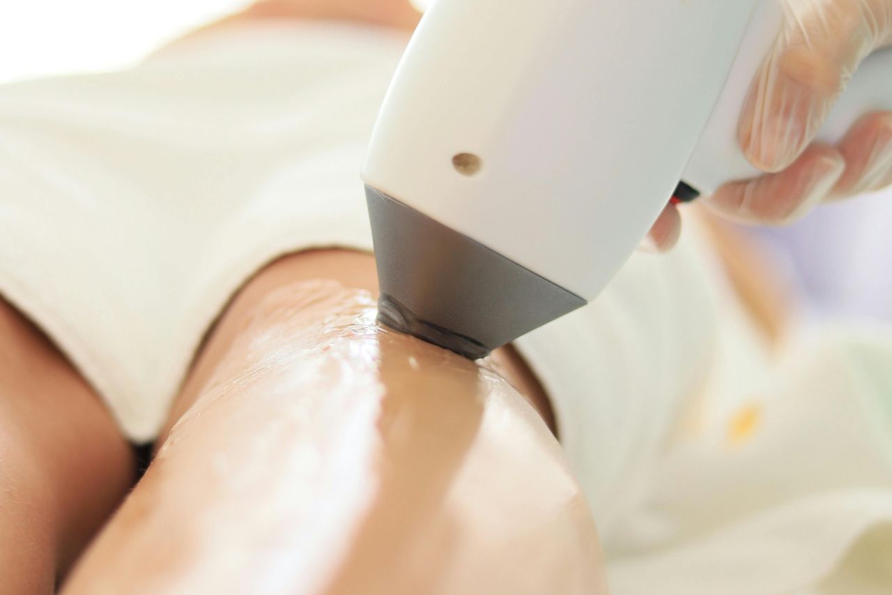 Epilazione Laser d’Estate vs Inverno: Qual è la Stagione Migliore per Iniziare?